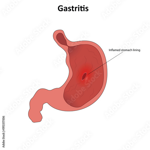 Gastritis vector illustration