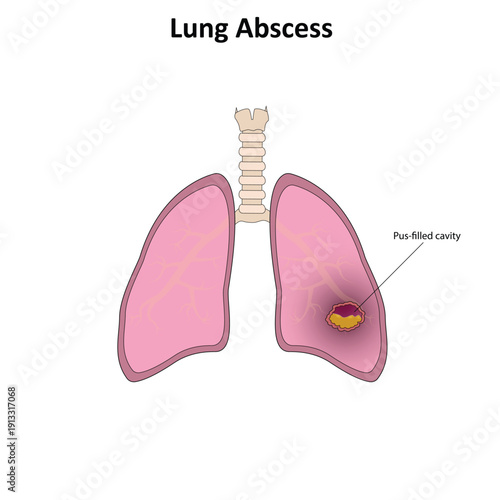 Lung abscess vector illustration