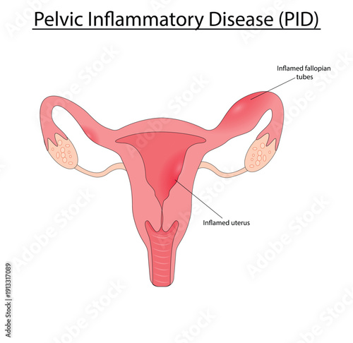 Pelvic inflammatory disease vector illustration