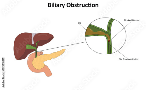 Biliary obstruction vector illustration