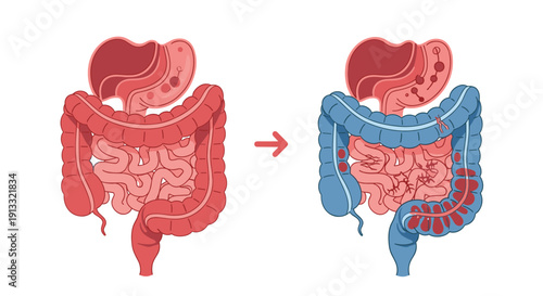 Medical illustration showing the progression of a disease in the human digestive system, comparing a healthy to a sick intestine.