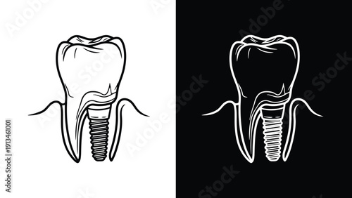 A detailed illustration showcases a human tooth with roots and a dental implant side by side