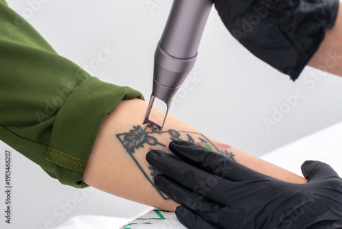 Εκτύπωση καμβά Cosmetologist removing tattoo with laser device female hand