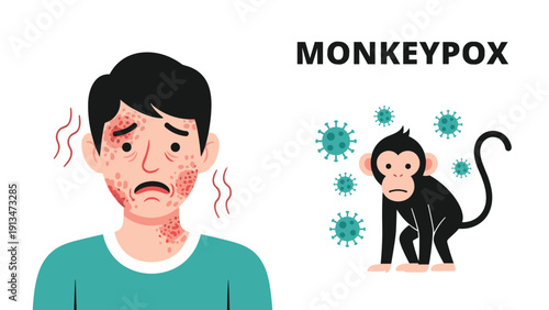 Medical infographic about monkeypox virus featuring a man with a red skin rash and an infected monkey surrounded by virus cells.