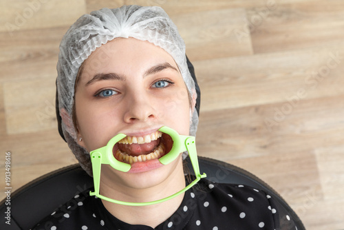 Tableau sur toile Patient with cheek retractor lying in dentist office