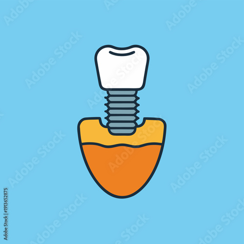 Dental implant structure diagram showing prosthetic crown and screw in jaw bone illustration