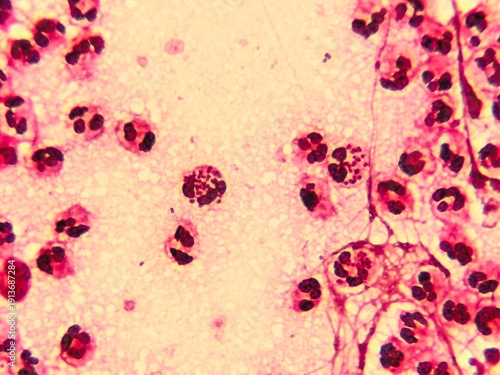 Quadro em tela Intracellular Neisseria gonorrhoeae bacteria with gram staining, viewed under a microscope