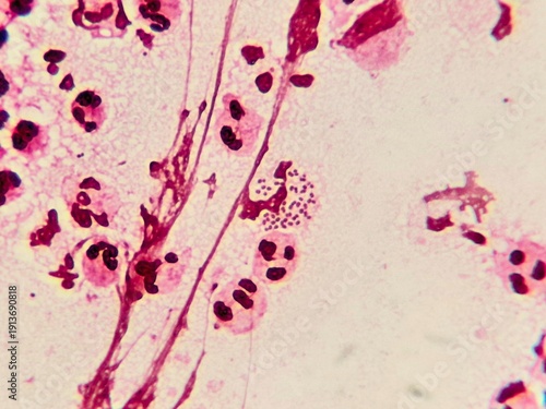 Quadro em tela Intracellular Neisseria gonorrhoeae bacteria with gram staining, viewed under a microscope