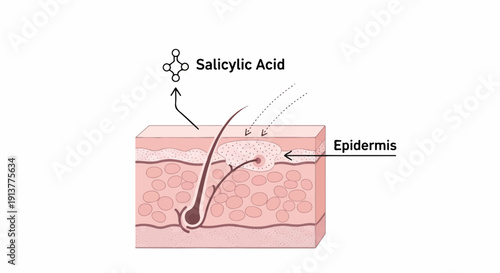 Diagram of salicylic acid interacting with skin's epidermis