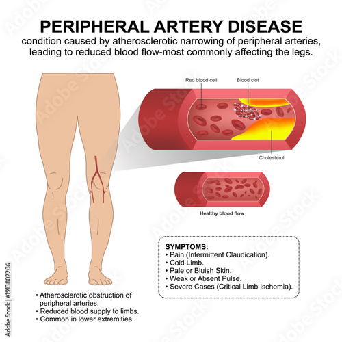 Peripheral Artery Disease (PAD) Flashcard