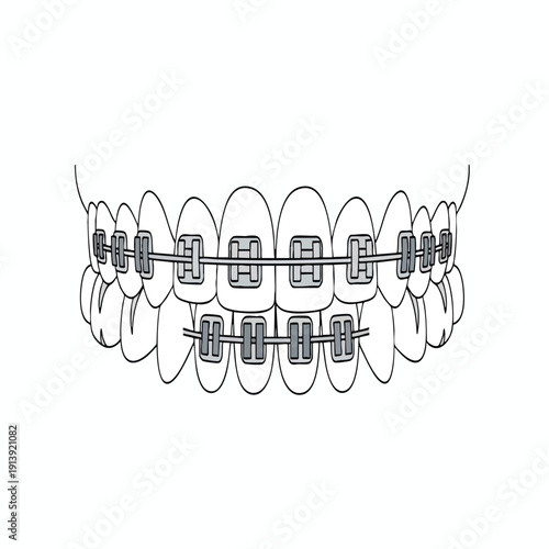 Orthodontic Braces Illustration