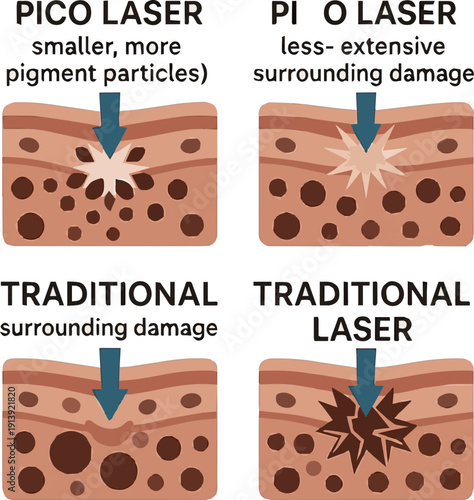 Isolated a realistic Pico laser vs traditional laser pigment breakdown comparison vector art with white background.