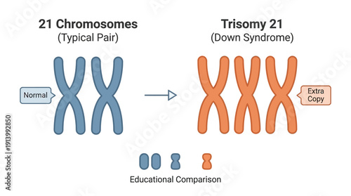 Down Syndrome Trisomy 21 Chromosomes, Extra Copy Comparison Genetic Illustration, Genetics Medical Education Science, Flat Vector Simple Design Blue Orange, Infographic White Background
