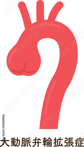 大動脈弁輪拡張症のイラスト annuloaortic ectasia(AAE)