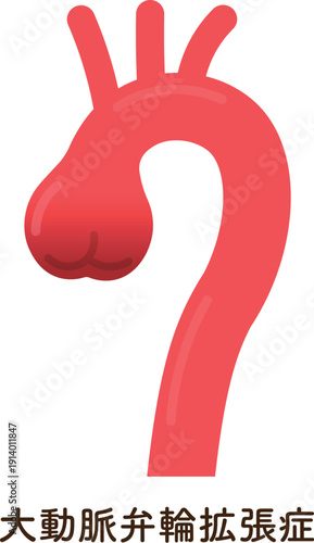 大動脈弁輪拡張症のイラスト annuloaortic ectasia(AAE)