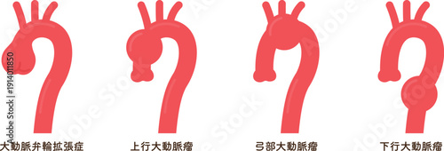 大動脈弁輪拡張症のイラスト annuloaortic ectasia(AAE)