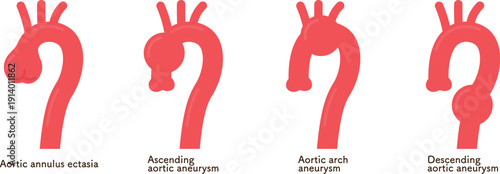 大動脈弁輪拡張症のイラスト annuloaortic ectasia(AAE)