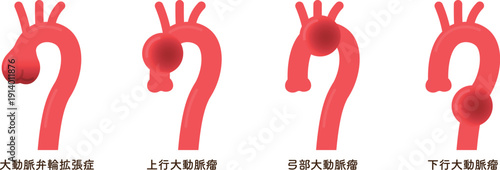 大動脈弁輪拡張症のイラスト annuloaortic ectasia(AAE)