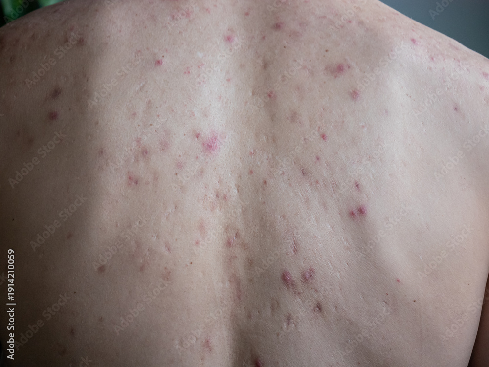 Fototapeta premium Man back with acne marks and pimples. Close up skin with blemishes. Health concept for dermatology, beauty, and treatment of skin problem.