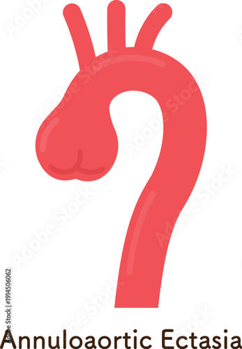 大動脈弁輪拡張症のイラスト annuloaortic ectasia(AAE)