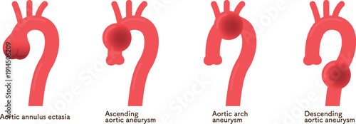 大動脈弁輪拡張症と大動脈瘤 annuloaortic ectasia&aortic aneurysm