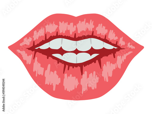 Eczematous Cheilitis Lip Disease Clip Art
