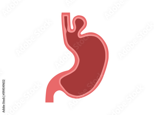 Hiatal Hernia Disease in Stomach
