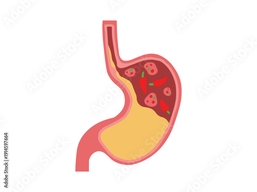 Dyspepsia Disease Stomach Clip Art
