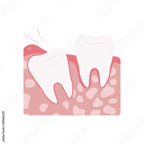 Tooth Decay Stages Illustration