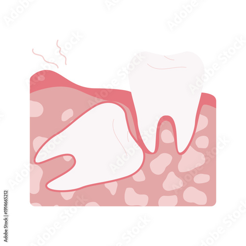 Tooth Decay Stages Illustration