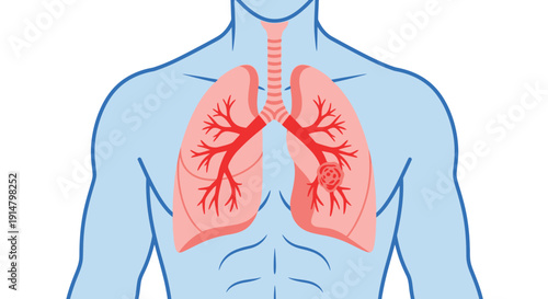 Illustration of human lungs with a highlighted tumor in the right lung