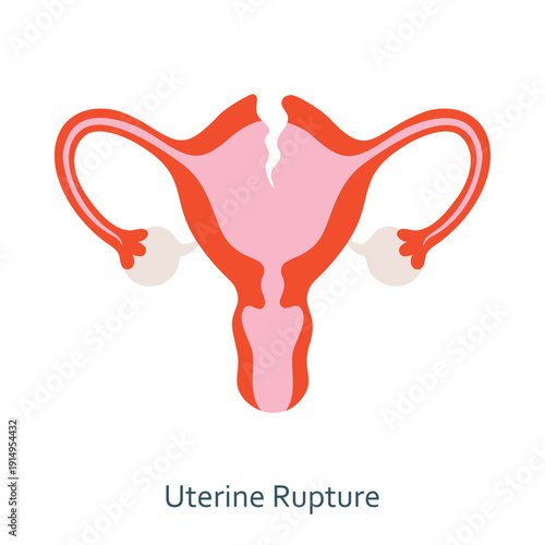 Uterine rupture. Tearing of uterine wall. Woman reproductive system anatomy. Human internal organ structure. Flat design medical illustration.