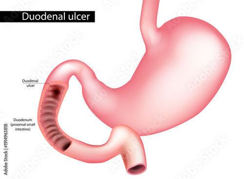 Duodenal Ulcer Medical Illustration of Stomach and Proximal Small Intestine Anatomy Peptic Ulcer Disease Diagram. Human Digestive System 