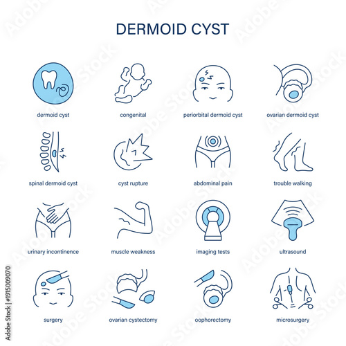 Dermoid Cyst symptoms, diagnostic and treatment vector icon set