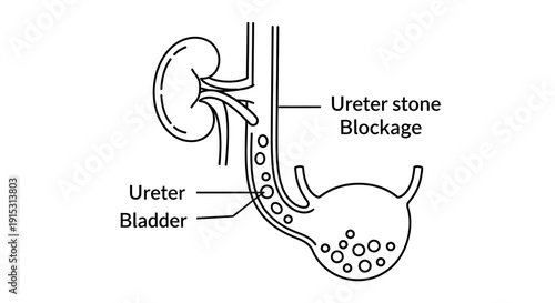 Diagram illustrating a ureter stone blockage and kidney stones in the human urinary system.
