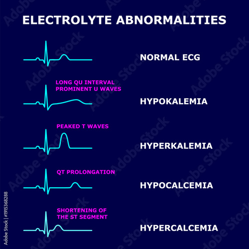 Electrolyte Abnormalities in ECG – hypokalemia, hyperkalemia, hypocalcemia and hypercalcemia. Medical vector illustration. ECG changes. Educational cardiology diagram isolated on dark blue background