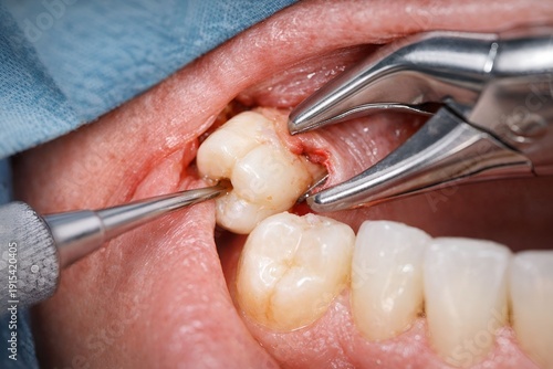 Surgical dental procedure. Remove a wisdom tooth. For healthcare, dentistry, medical education, oral hygiene concepts, and dental treatment advertisements