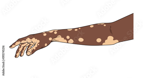 Illustration of a human arm with skin condition vitiligo, showing depigmentation on the forearm and hand from a lateral viewpoint