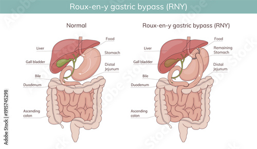 Roux-en-Y gastric bypass. Vector illustration