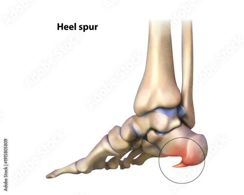 Heel spur. Isolated vector illustration