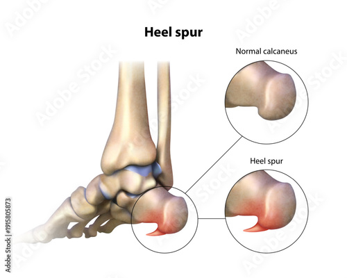 Heel spurs. Isolated vector illustration