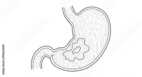 Stomach Ulcer Illustration: Medical Diagram of Gastric Lesion and Digestion Tract