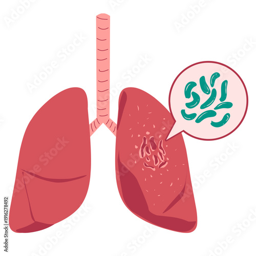 Tuberculosis disease illustration. World tuberculosis day concept