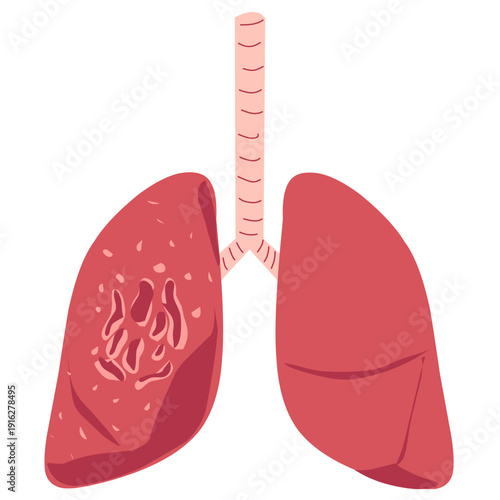 Tuberculosis illustration 