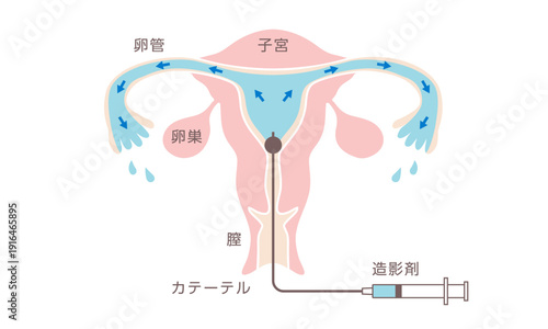 卵管造影検査の説明イラスト（日本語）
