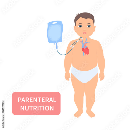 Young patient receiving parenteral nutrition through a central intravenous IV access. Clinical feeding therapy in critical care for malnourished pediatric patients in hospitals. Vector illustration.