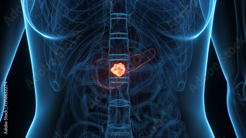 A Detailed 3D Depiction Of Pancreatic Cancer In A Woman