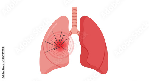 Human lungs with damaged left lung and needles
