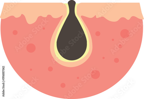 Clogged skin pore. Cartoon blackhead problem icon