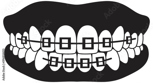 Detailed illustration of teeth with orthodontic braces on upper and lower dental arches for straightening and alignment purposes